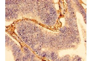 Immunohistochemistry of paraffin-embedded human colon cancer using ABIN7175699 at dilution of 1:100