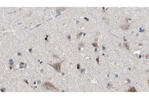 ABIN6272876 at 1/100 staining Human brain cancer tissue by IHC-P. (IFT81 Antikörper)