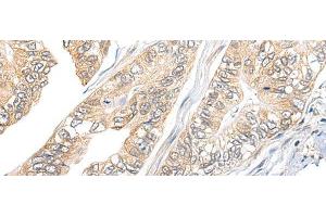 Immunohistochemistry of paraffin-embedded Human gastric cancer tissue using TBCB Polyclonal Antibody at dilution of 1:25(x200) (TBCB Antikörper)