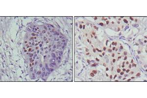 Immunohistochemical analysis of paraffin-embedded human esophageal cancer (left) and lung cancer (right), showing nuclear localization using p53 mouse mAb with DAB staining.