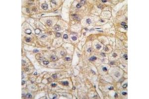 IHC analysis of FFPE human hepatocarcinoma tissue stained with the EGF Receptor antibody (EGFR Antikörper  (AA 1048-1077))