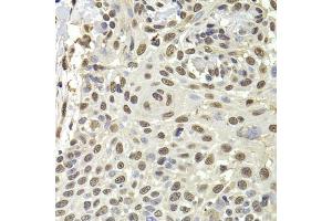 Immunohistochemistry of paraffin-embedded human well-differentiated squamous skin carcinoma using PUF60 antibody. (PUF60 Antikörper)
