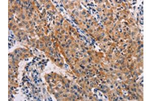 The image on the left is immunohistochemistry of paraffin-embedded Human lung cancer tissue using ABIN7128260(ADH1A Antibody) at dilution 1/20, on the right is treated with fusion protein. (ADH1A Antikörper)