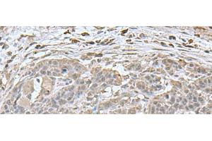 Immunohistochemistry of paraffin-embedded Human esophagus cancer tissue using NEUROG3 Polyclonal Antibody at dilution of 1:70(x200) (Neurogenin 3 Antikörper)