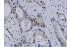 Formalin-fixed and paraffin embedded human colon labeled with Anti Styk1 Polyclonal Antibody, Unconjugated  followed by conjugation to the secondary antibody and DAB staining (STYK1 Antikörper  (AA 51-150))