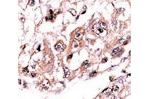 IHC analysis of FFPE human hepatocarcinoma stained with the PPP3CC antibody (PPP3CC Antikörper  (AA 482-512))