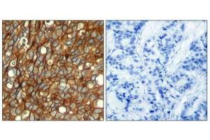 Immunohistochemical analysis of paraffin-embedded human breast carcinoma tissue using HER2 (Phospho-Tyr1248) Antibody (left) or the same antibody preincubated with blocking peptide (right). (ErbB2/Her2 Antikörper  (pTyr1248))