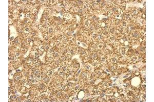 IHC-P Image SUCLG2 antibody detects SUCLG2 protein at cytosol on human hepatoma by immunohistochemical analysis. (SUCLG2 Antikörper)