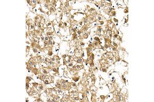 Immunohistochemistry of paraffin-embedded human liver cancer using Smad9 Rabbit pAb (ABIN6132668, ABIN6148096, ABIN6148097 and ABIN6223425) at dilution of 1:100 (40x lens). (SMAD9 Antikörper  (AA 1-300))
