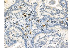 ABIN6264995 and ABIN6273073 at 1/100 staining Human lung cancer by IHC-P. (Septin 9 Antikörper  (C-Term))