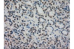 Immunohistochemical staining of paraffin-embedded Carcinoma of thyroid tissue using anti-STK39mouse monoclonal antibody. (STK39 Antikörper)