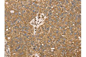 The image on the left is immunohistochemistry of paraffin-embedded Human breast cancer tissue using ABIN7130945(RRBP1 Antibody) at dilution 1/25, on the right is treated with fusion protein. (RRBP1 Antikörper)