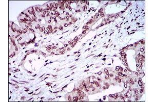 Immunohistochemical analysis of paraffin-embedded rectum cancer tissues using ZEB1 mouse mAb with DAB staining. (ZEB1 Antikörper  (AA 967-1108))