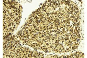 ABIN6273407 at 1/100 staining Human breast cancer tissue by IHC-P. (TSEN2 Antikörper  (Internal Region))
