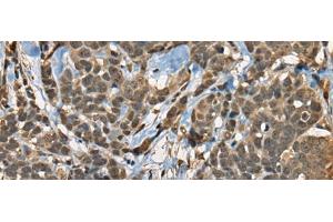 Immunohistochemistry of paraffin-embedded Human thyroid cancer tissue using CIR1 Polyclonal Antibody at dilution of 1:40(x200) (CIR1 Antikörper)