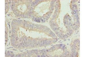 Immunohistochemistry of paraffin-embedded human endometrial cancer using ABIN7146467 at dilution of 1:100 (Calmegin Antikörper  (AA 200-400))