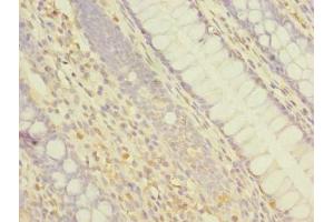 Immunohistochemistry of paraffin-embedded human colon cancer using ABIN7144926 at dilution of 1:100 (ABCF3 Antikörper  (AA 201-500))