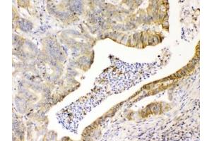 IHC testing of FFPE human intestinal cancer tissue with CD147 antibody at 1ug/ml. (CD147 Antikörper)