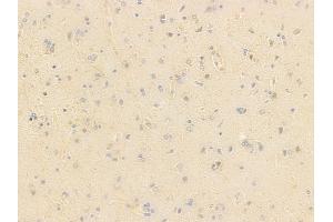 ABIN7096979 and ABIN7101046 at 1/100 staining human glioblastoma by IHC-P. (ZNF696 Antikörper)