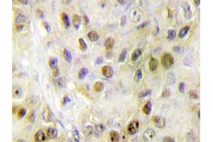 Immunohistochemical analysis of paraffin-embedded human breast cancer tissue using RORA polyclonal antibody . (RORA Antikörper)