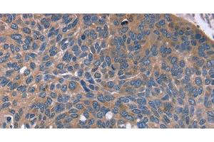 Immunohistochemistry of paraffin-embedded Human esophagus cancer tissue using RGS4 Polyclonal Antibody at dilution 1:30 (RGS4 Antikörper)