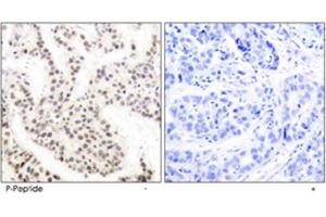 Immunohistochemical analysis of paraffin-embedded human breast carcinoma tissue using ELK1 (phospho T417) polyclonal antibody. (ELK1 Antikörper  (pThr417))