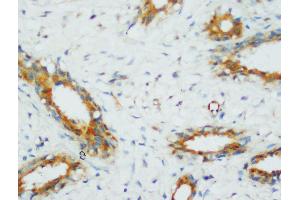 Anti-PP2A antibody, IHC(P) IHC(P): Human Mammary Cancer Tissue (PPP2CA Antikörper  (N-Term))