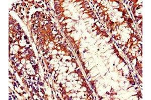 Immunohistochemistry of paraffin-embedded human colon cancer using ABIN7168038 at dilution of 1:100 (RHOH Antikörper  (AA 1-188))