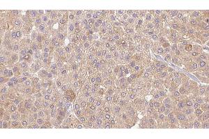 ABIN6273654 at 1/100 staining Human Melanoma tissue by IHC-P. (IL36A/IL1F6 Antikörper  (Internal Region))