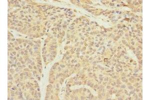 Immunohistochemistry of paraffin-embedded human ovarian cancer using ABIN7159905 at dilution of 1:100 (TIMM23 Antikörper  (AA 1-209))