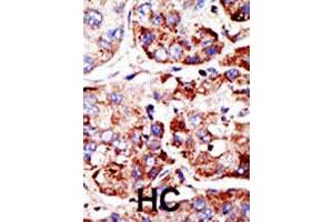 Formalin-fixed and paraffin-embedded human hepatocellular carcinoma tissue reacted with PIAS2 polyclonal antibody , which was peroxidase-conjugated to the secondary antibody, followed by DAB staining. (PIAS2 Antikörper  (C-Term))