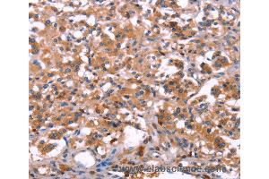 Immunohistochemistry of Human thyroid cancer using LILRB1 Polyclonal Antibody at dilution of 1:30