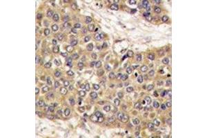 IHC analysis of FFPE human hepatocarcinoma tissue stained with Caspase-6 antibody (Caspase 6 Antikörper  (AA 235-263))