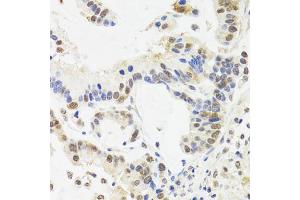 Immunohistochemistry of paraffin-embedded human gastric cancer using SUZ12 antibody (ABIN5975314) at dilution of 1/100 (40x lens). (SUZ12 Antikörper)