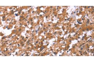 Immunohistochemistry of paraffin-embedded Human thyroid cancer using HSD17B1 Polyclonal Antibody at dilution of 1:40 (HSD17B1 Antikörper)