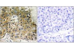 Immunohistochemistry analysis of paraffin-embedded human breast carcinoma, using Integrin beta1 (Phospho-Thr789) Antibody. (ITGB1 Antikörper  (pThr789))