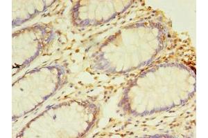 Immunohistochemistry of paraffin-embedded human colon cancer using ABIN7161747 at dilution of 1:100 (NAIF1 Antikörper  (AA 1-172))