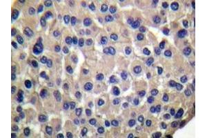 Immunohistochemistry analyzes of Mucin 1 antibody in paraffin-embedded human breast carcinoma. (MUC1 Antikörper)