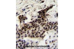 UBXN2A Antibody (C-term) immunohistochemistry analysis in formalin fixed and paraffin embedded human bladder carcinoma followed by peroxidase conjugation of the secondary antibody and DAB staining. (UBXN2A Antikörper  (C-Term))