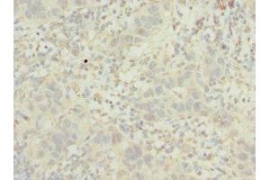 Immunohistochemistry of paraffin-embedded human bladder cancer using ABIN7163723 at dilution of 1:100 (POC1B Antikörper  (AA 299-478))