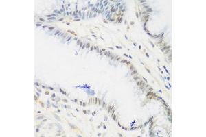 Immunohistochemistry of paraffin-embedded human gastric using IGF2BP3 antibody at dilution of 1:200 (40x lens).