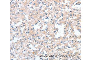 Immunohistochemistry of Human thyroid cancer using WNT3A Polyclonal Antibody at dilution of 1:40 (WNT3A Antikörper)
