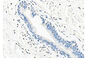 ABIN7093766, ABIN7097800 and ABIN7097801 at 1/100 staining Human liver cancer by IHC-P.