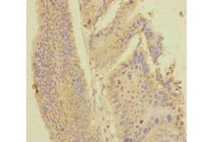Immunohistochemistry of paraffin-embedded human colon cancer using ABIN7168416 at dilution of 1:100 (PDE6A Antikörper  (AA 656-860))