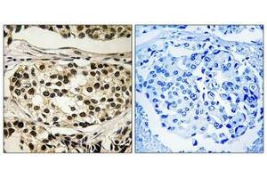Immunohistochemical analysis of paraffin-embedded human breast carcinoma tissue using Cyclin C (Phospho-Ser275) antibody (left)or the same antibody preincubated with blocking peptide (right). (Cyclin C Antikörper  (pSer275))