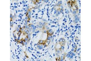 Immunohistochemistry of paraffin-embedded Human gastric cancer using MMP7 Polyclonal Antibody at dilution of 1:100 (40x lens). (MMP7 Antikörper)