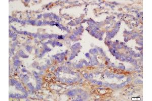 Formalin-fixed and paraffin embedded human lung carcinoma labeled with Anti-IL-12 beta Polyclonal Antibody, Unconjugated  at 1:200 followed by conjugation to the secondary antibody and DAB staining. (IL12B Antikörper  (AA 201-300))