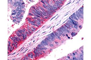 Anti-FZD7 / Frizzled 7 antibody IHC of human Colon, Carcinoma. (FZD7 Antikörper  (N-Term))