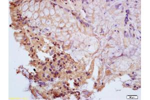 Formalin-fixed and paraffin embedded human colon carcinoma labeled with Anti-Phospho-PPAR Gamma (ser112) Polyclonal Antibody, Unconjugated (ABIN703405) at 1:200, followed by conjugation to the secondary antibody and DAB staining (PPARG Antikörper  (pSer112))