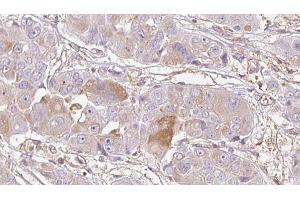ABIN6272735 at 1/100 staining Human liver cancer tissue by IHC-P. (LPAR4 Antikörper  (C-Term))